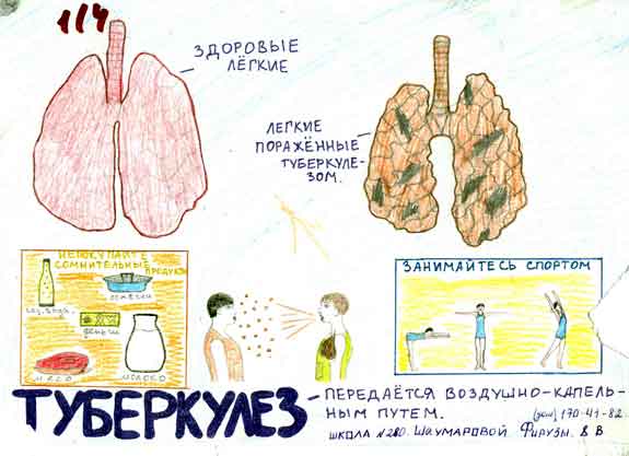 ​В Кузбассе эпидемия туберкулеза