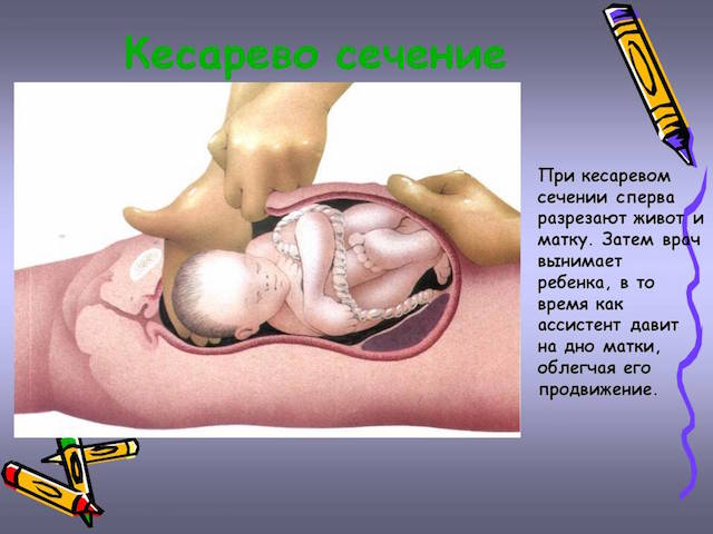 Кесарево сечение